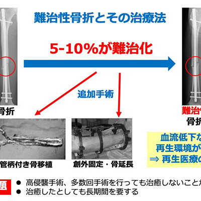 難治性骨折（偽関節）患者に対する再生医療：CD34陽性細胞移植の研究支援