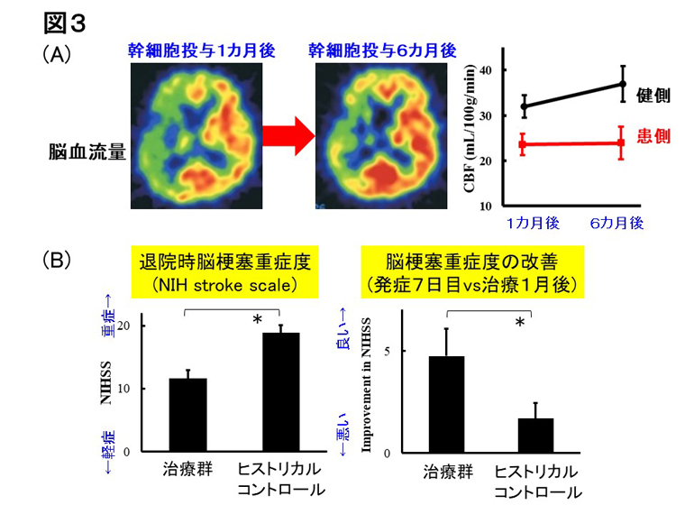図3 脳梗塞患者に対する自己造血幹細胞移植治療による脳循環代謝の改善